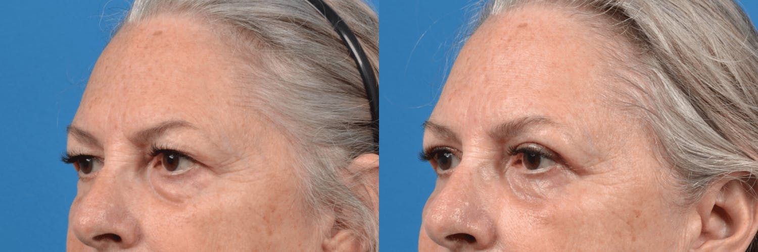 Eyelid Surgery Before & After Gallery - Patient 122444725 - Image 2
