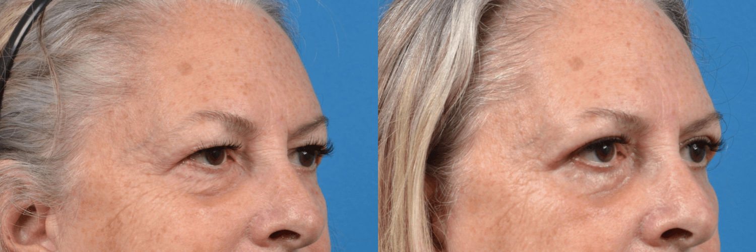 Eyelid Surgery Before & After Gallery - Patient 125858 - Image 3