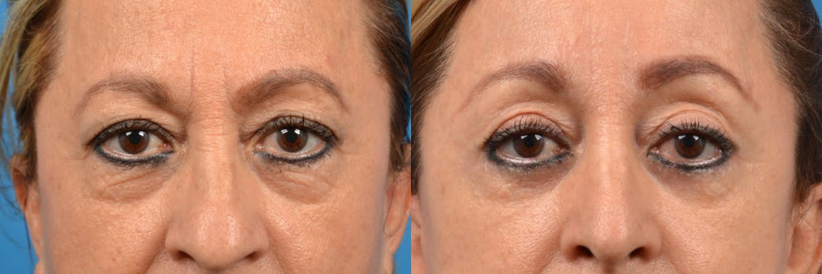 Eyelid Surgery Before & After Gallery - Patient 122444727 - Image 1