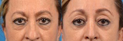 Eyelid Surgery Before & After Gallery - Patient 122444727 - Image 1