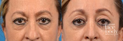 Eyelid Surgery Before & After Gallery - Patient 679584 - Image 1