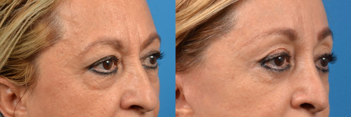 Eyelid Surgery Before & After Gallery - Patient 122444727 - Image 2