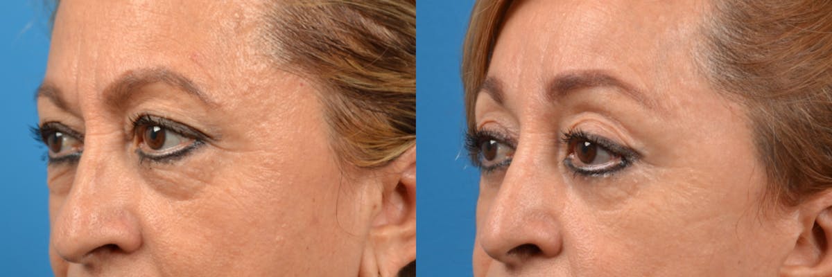 Eyelid Surgery Before & After Gallery - Patient 122444727 - Image 3