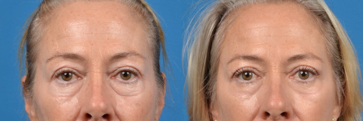 Eyelid Surgery Before & After Gallery - Patient 122444729 - Image 1