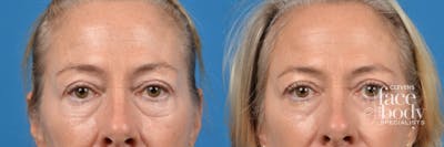 Eyelid Surgery Before & After Gallery - Patient 183997 - Image 1