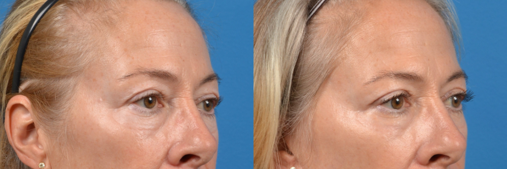 Eyelid Surgery Before & After Gallery - Patient 183997 - Image 2