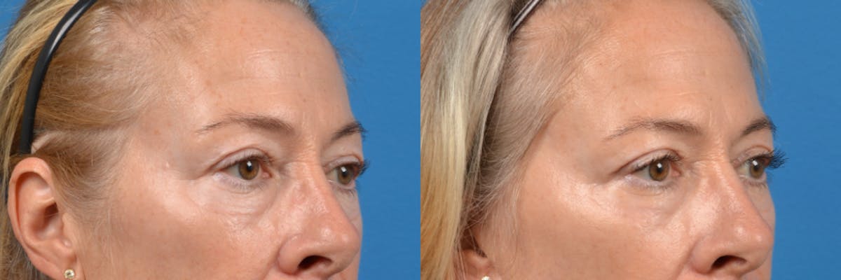 Eyelid Surgery Before & After Gallery - Patient 122444729 - Image 2