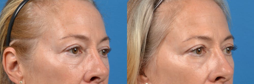 Eyelid Surgery Before & After Gallery - Patient 122444729 - Image 2