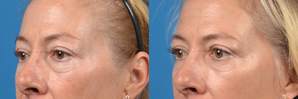 Eyelid Surgery Before & After Gallery - Patient 122444729 - Image 3