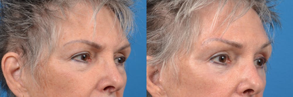 Eyelid Surgery Before & After Gallery - Patient 122444731 - Image 2