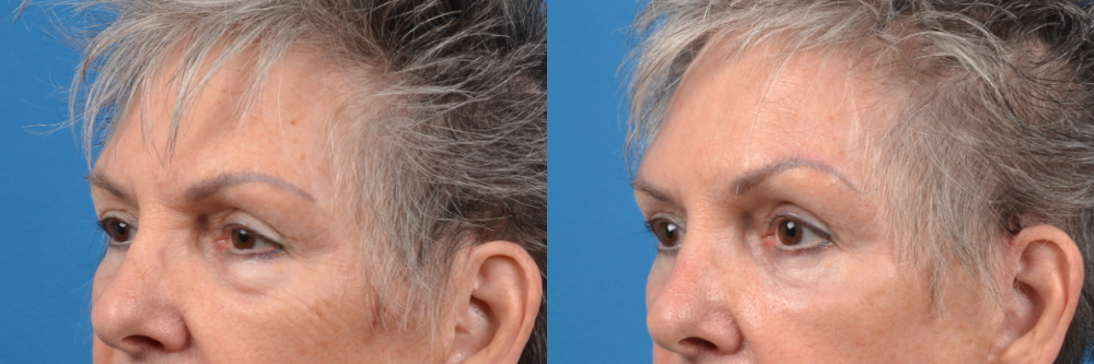 Eyelid Surgery Before & After Gallery - Patient 211956 - Image 3