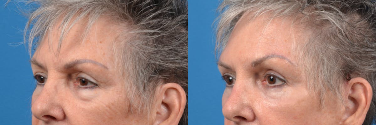 Eyelid Surgery Before & After Gallery - Patient 122444731 - Image 3