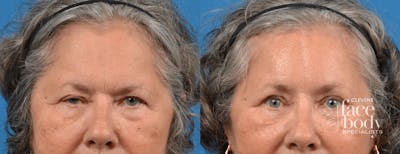 Eyelid Surgery Before & After Gallery - Patient 194669 - Image 1