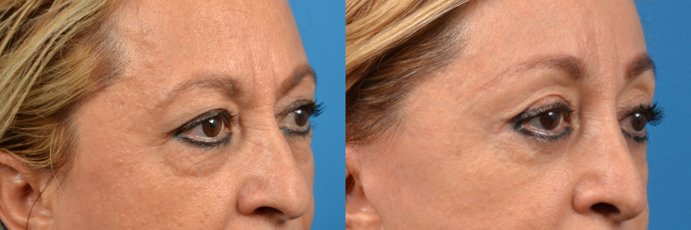 Eyelid Surgery Before & After Gallery - Patient 679584 - Image 2