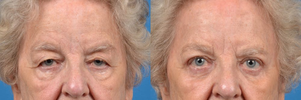 Eyelid Surgery Before & After Gallery - Patient 122444734 - Image 1