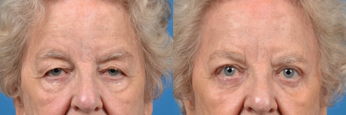 Eyelid Surgery Before & After Gallery - Patient 122444734 - Image 1