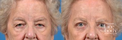 Eyelid Surgery Before & After Gallery - Patient 291256 - Image 1