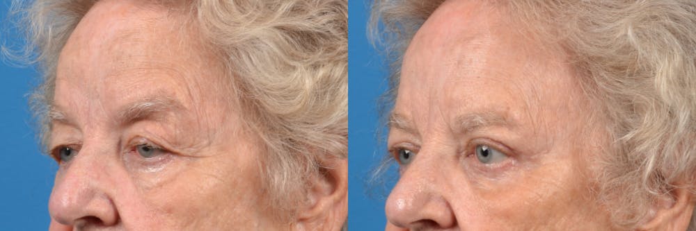 Eyelid Surgery Before & After Gallery - Patient 122444734 - Image 2