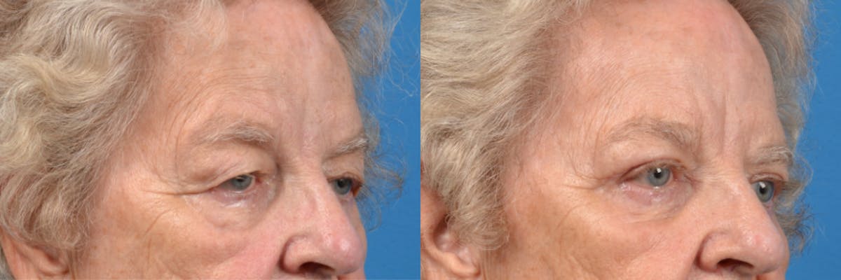 Eyelid Surgery Before & After Gallery - Patient 122444734 - Image 3