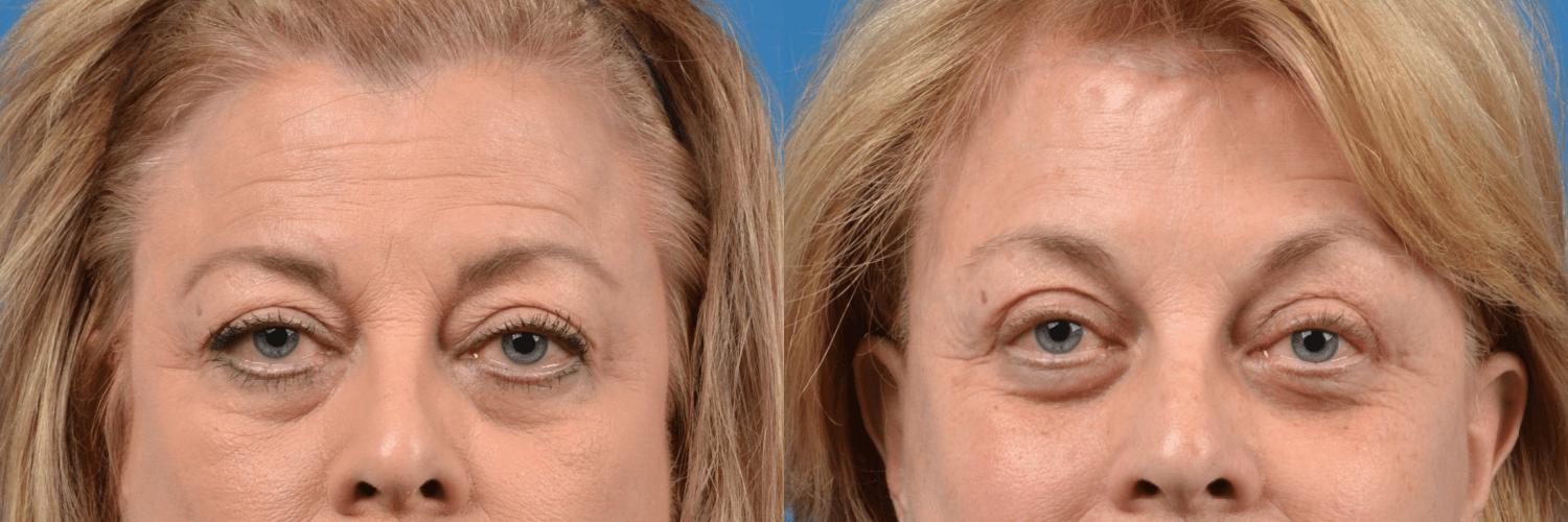Eyelid Surgery Before & After Gallery - Patient 258830 - Image 1