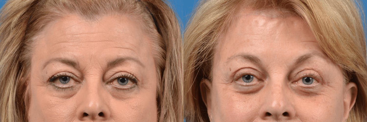 Eyelid Surgery Before & After Gallery - Patient 122444740 - Image 1