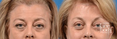 Eyelid Surgery Before & After Gallery - Patient 258830 - Image 1