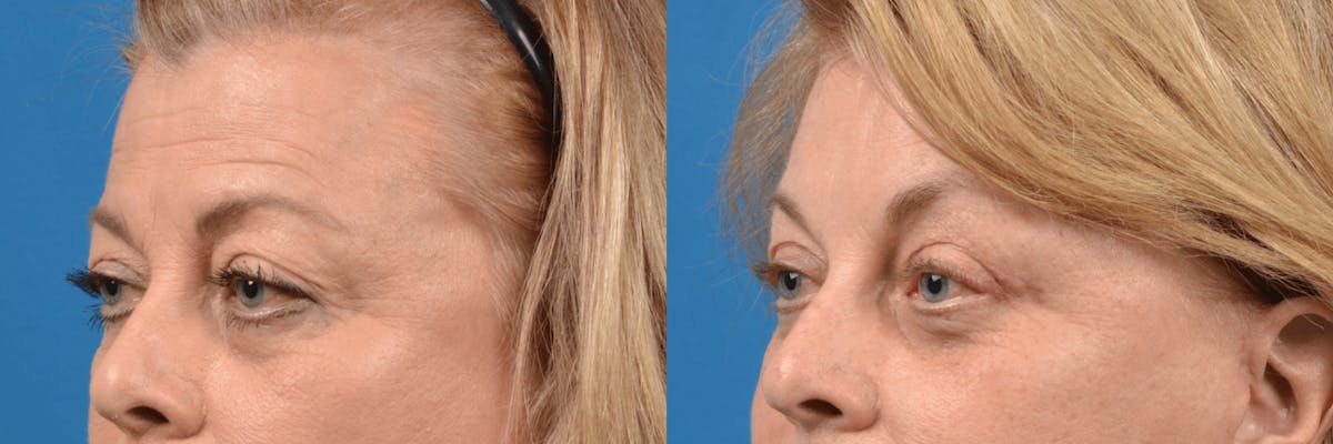 Eyelid Surgery Before & After Gallery - Patient 122444740 - Image 2