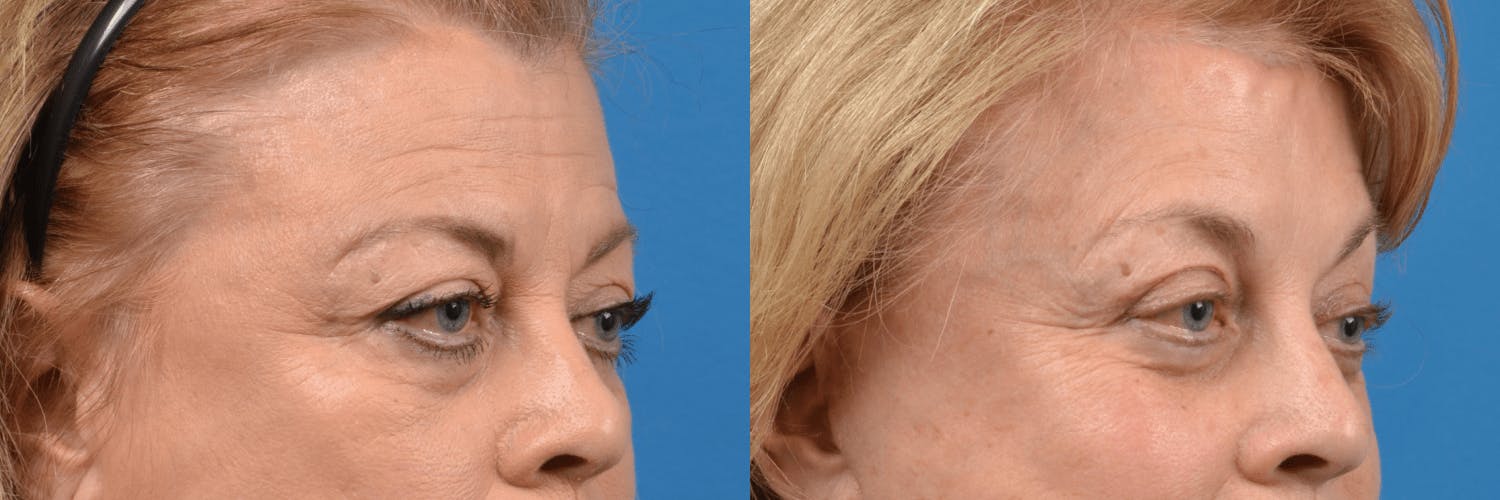 Eyelid Surgery Before & After Gallery - Patient 122444740 - Image 3