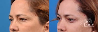 Eyelid Surgery Before & After Gallery - Patient 209739 - Image 1