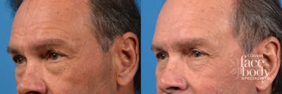 Eyelid Surgery Before & After Gallery - Patient 171999 - Image 1