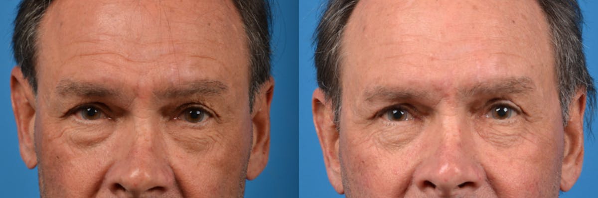 Eyelid Surgery Before & After Gallery - Patient 122444752 - Image 2