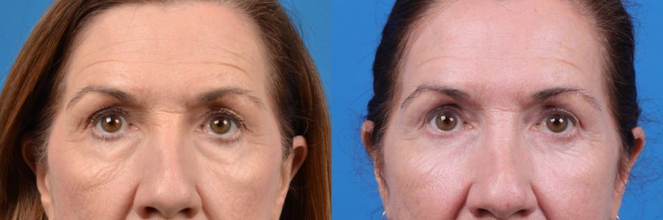 Eyelid Surgery Before & After Gallery - Patient 303496 - Image 1
