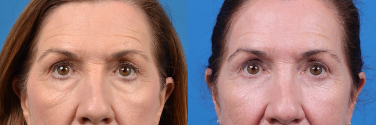 Eyelid Surgery Before & After Gallery - Patient 122444758 - Image 1