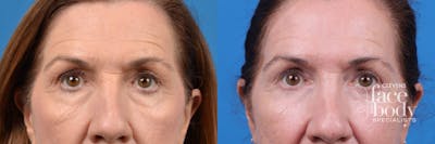 Eyelid Surgery Before & After Gallery - Patient 303496 - Image 1