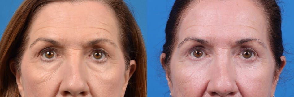 Eyelid Surgery Before & After Gallery - Patient 122444758 - Image 1