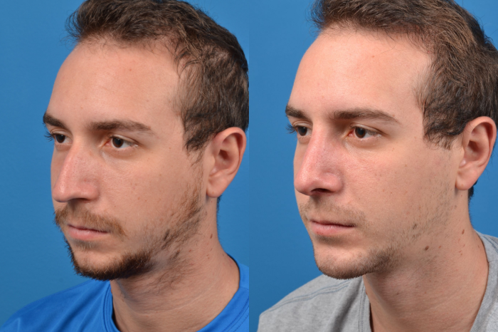 Eyelid Surgery Before & After Gallery - Patient 303496 - Image 2