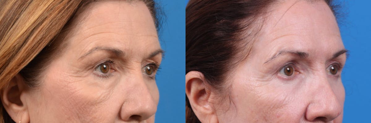 Eyelid Surgery Before & After Gallery - Patient 122444758 - Image 3
