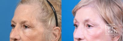 Eyelid Surgery Before & After Gallery - Patient 202435 - Image 1