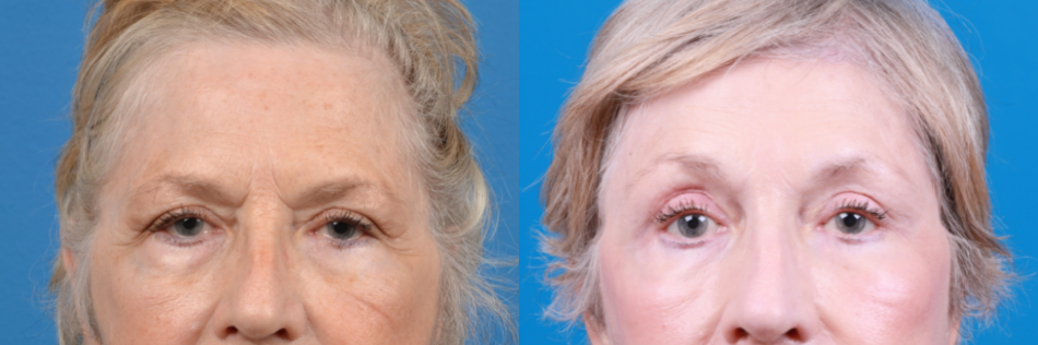 Eyelid Surgery Before & After Gallery - Patient 202435 - Image 2