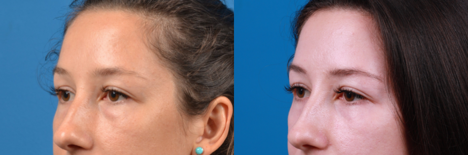 Eyelid Surgery Before & After Gallery - Patient 426518 - Image 1