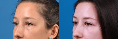Eyelid Surgery Before & After Gallery - Patient 122444767 - Image 1