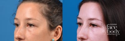 Eyelid Surgery Before & After Gallery - Patient 426518 - Image 1