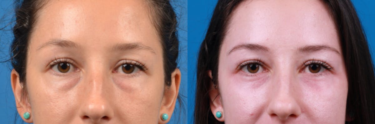 Eyelid Surgery Before & After Gallery - Patient 122444767 - Image 2