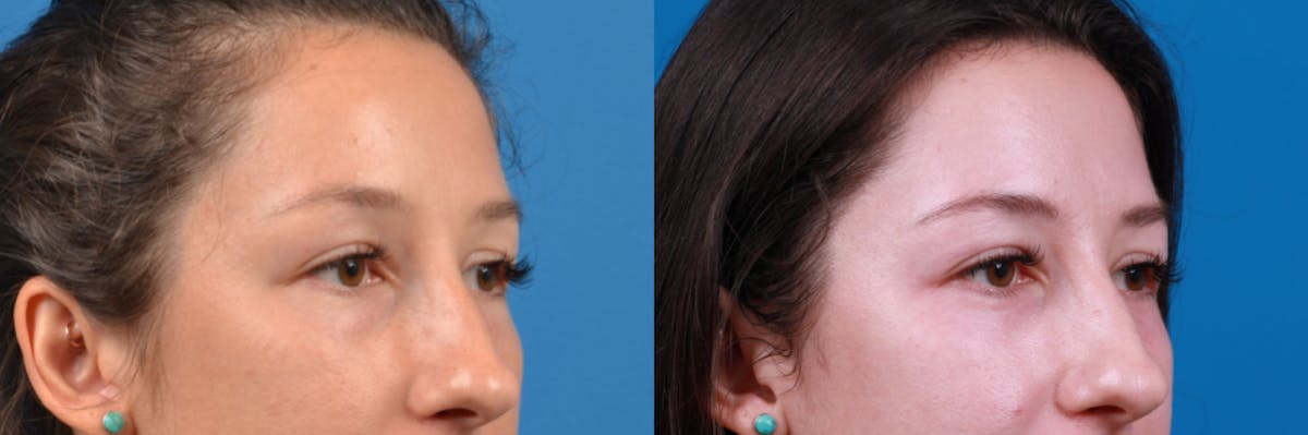 Eyelid Surgery Before & After Gallery - Patient 122444767 - Image 3