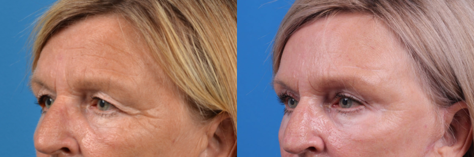 Eyelid Surgery Before & After Gallery - Patient 367368 - Image 1