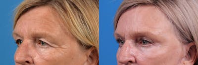 Eyelid Surgery Before & After Gallery - Patient 122444770 - Image 1