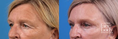 Eyelid Surgery Before & After Gallery - Patient 367368 - Image 1