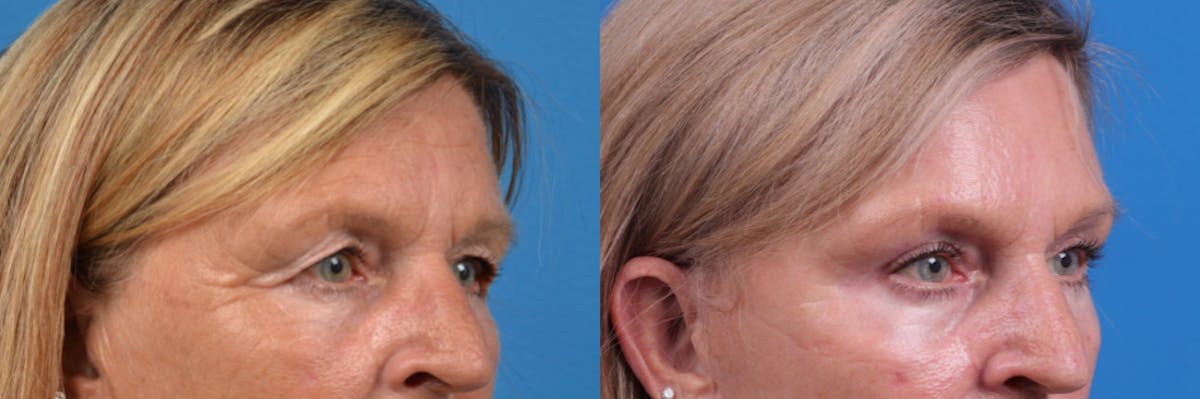 Eyelid Surgery Before & After Gallery - Patient 122444770 - Image 3