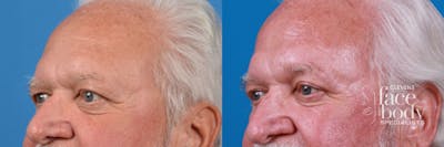 Eyelid Surgery Before & After Gallery - Patient 182883 - Image 1