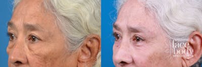 Eyelid Surgery Before & After Gallery - Patient 404477 - Image 1